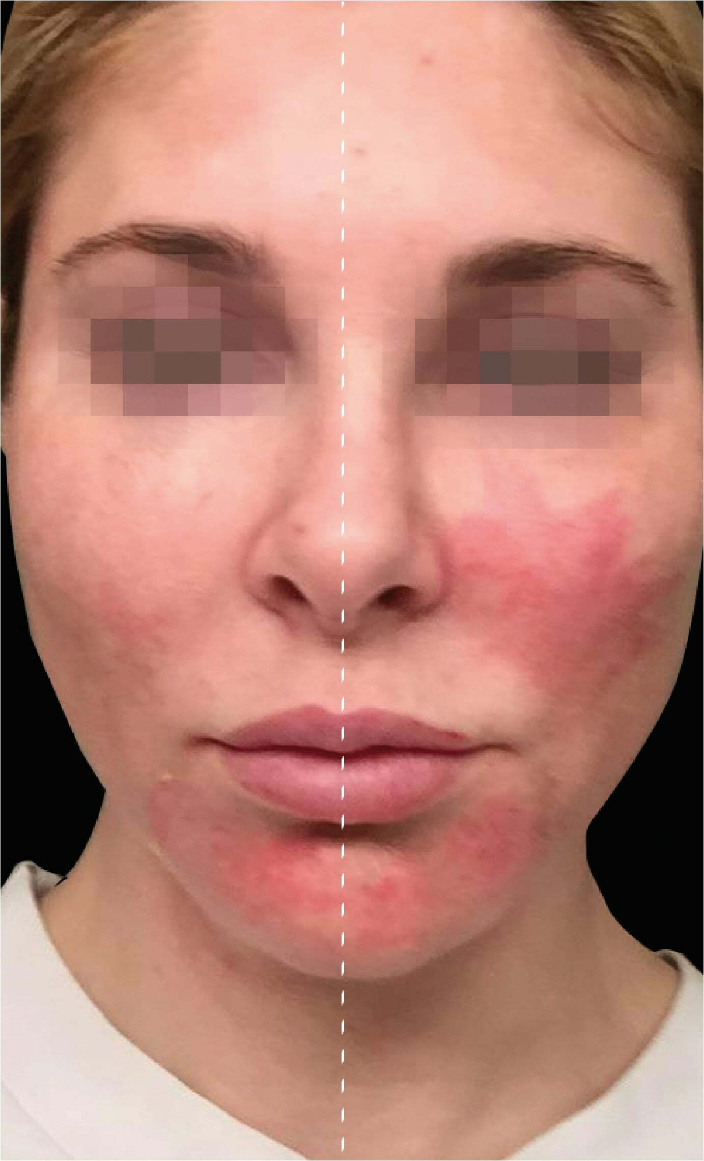 Why is Treatment Enhancement so important post procedure? AESTHETICARE